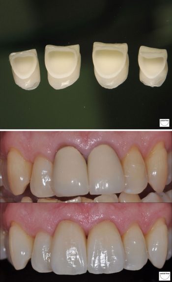Crowns-new Crowns-new