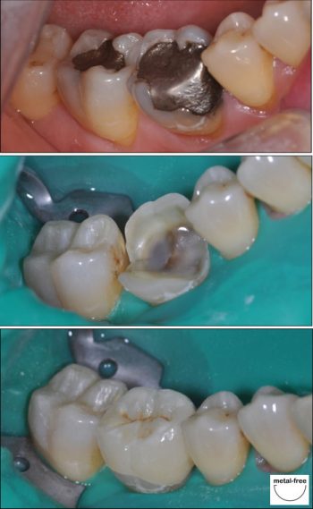 Porcelain-fillings Porcelain-fillings